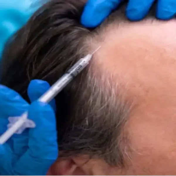 Best Specialist for exosomes hair therapy in islamabad