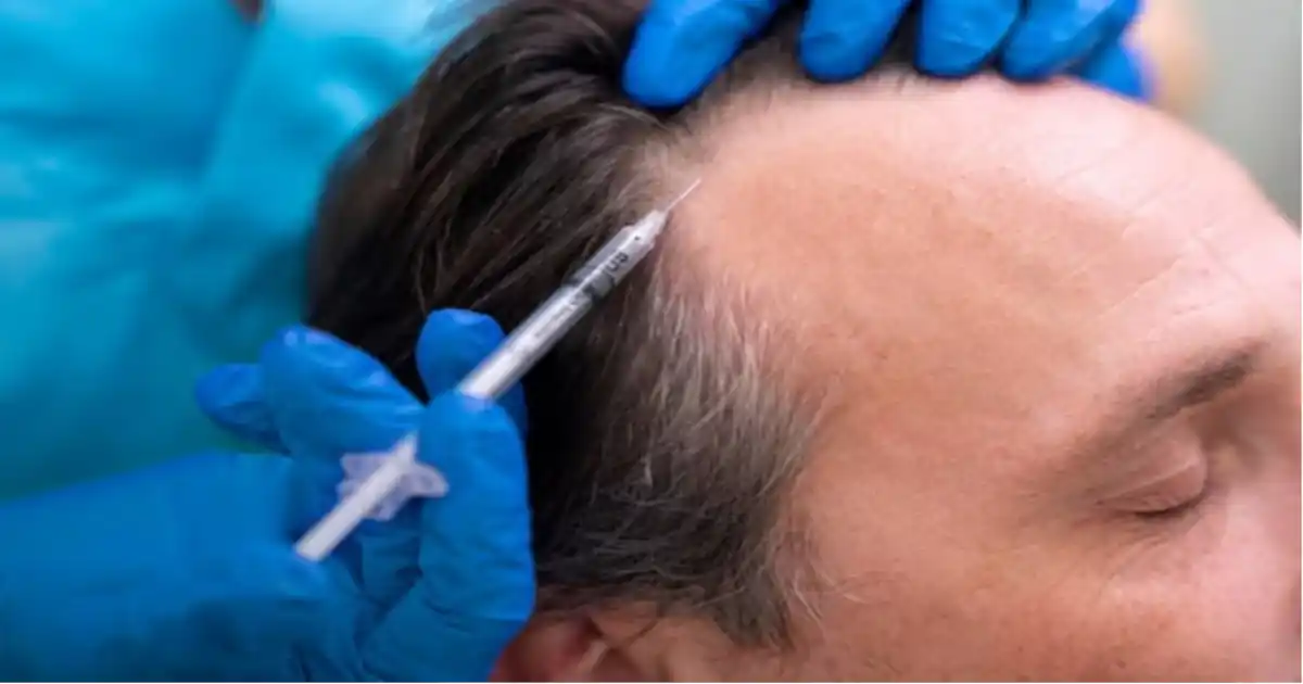 Best Specialist for exosomes hair therapy in islamabad